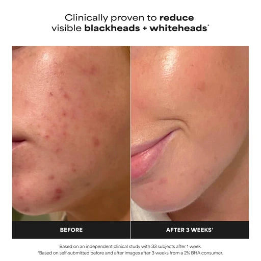 Paulas Choice SKIN PERFECTING 2% BHA Liquid Leave-On Exfoliant