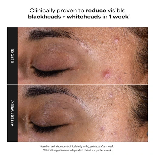 Paulas Choice SKIN PERFECTING 2% BHA Liquid Leave-On Exfoliant