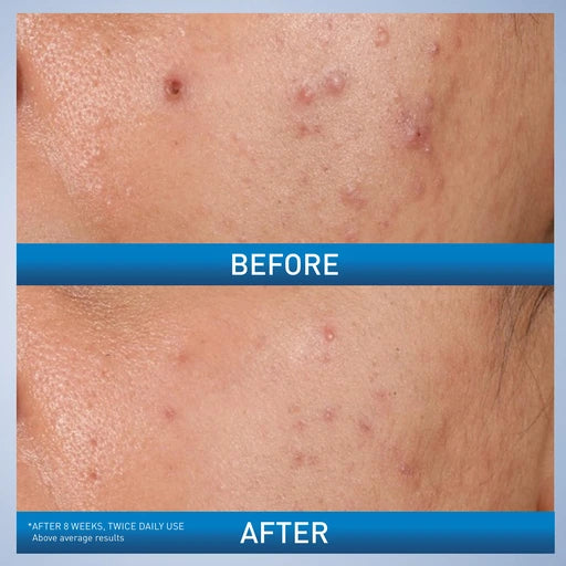 CeraVe Acne Control Gel, Salicylic & Glycolic Acid Face Treatment, 1.35oz